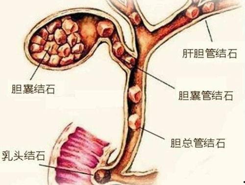 胆管结石可以吃小瓜,小瓜助力健康生活
